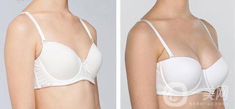 隆胸材料有哪些牌子？有哪些優(yōu)缺點(diǎn)？