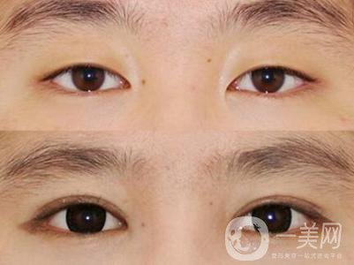 高分子雙眼皮是*嗎?高分子雙眼皮適合哪些人？