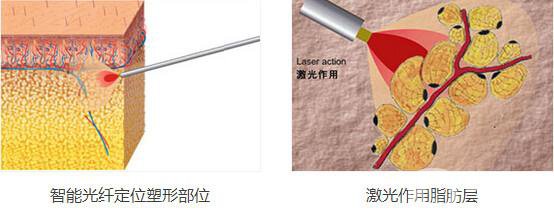 光纖溶脂減肥*果嗎?有哪些注意事項(xiàng)？