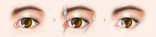 開眼角有危險嗎？有些什么后遺癥？
