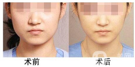 咬肌發(fā)達(dá)怎么辦 怎么瘦臉部咬肌*