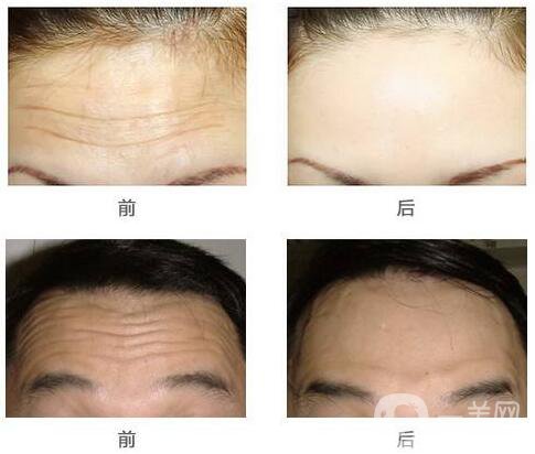 怎么樣去掉抬頭紋 去抬頭紋有什么方法