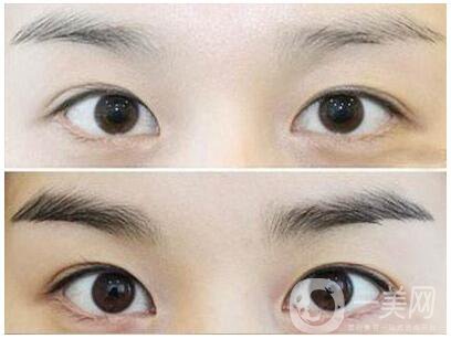 南京繡眉價(jià)格是多少 費(fèi)用分析