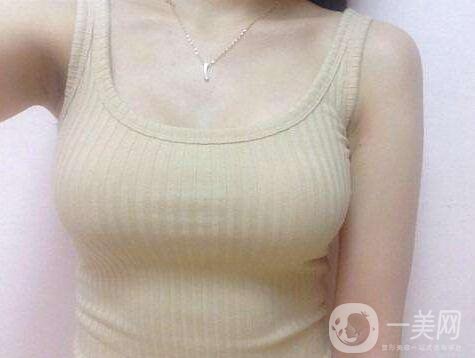 娜高假體隆胸多少錢？收費(fèi)情況說明~