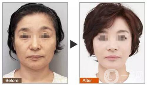 *要花多少錢 *除皺價格要多少