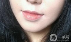 墊下巴后多久可以按摩 術(shù)后如何護(hù)理