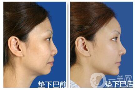 墊下巴后多久可以按摩 術(shù)后如何護(hù)理