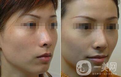 光子嫩膚大概要多少錢？光子嫩膚價格詳解