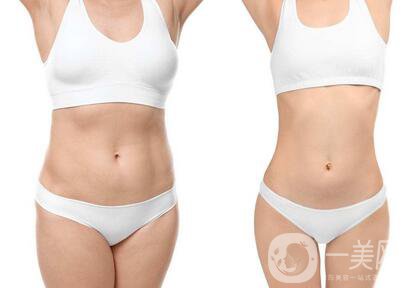 南京吸脂減肥價格是多少？收費(fèi)明細(xì)~