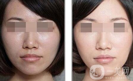 彩光嫩膚要多少錢？彩光嫩膚價(jià)格需要多少？