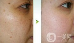 光子嫩膚調(diào)節(jié)黃褐斑果怎么樣？去黃褐斑圖