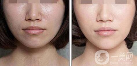 光子嫩膚如何護理？光子嫩膚的注意事項