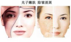 光子嫩膚如何護(hù)理？光子嫩膚的注意事項(xiàng)