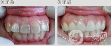 四環(huán)素牙怎么變白？四環(huán)素牙怎么辦？