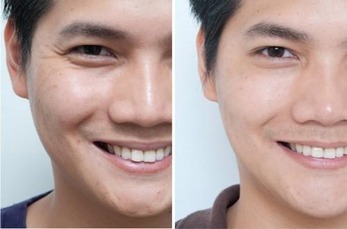 去魚尾紋的方法有哪些？玻尿酸去魚尾紋怎么樣？