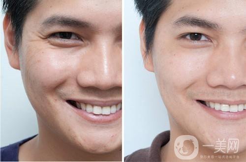 去魚(yú)尾紋的方法有哪些？玻尿酸去魚(yú)尾紋怎么樣？