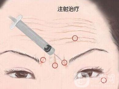 *生物除皺*果好不好？有副作用嗎？