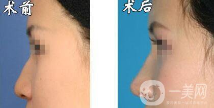 瑞蘭玻尿酸隆鼻價格需要多少?所需費(fèi)用詳解