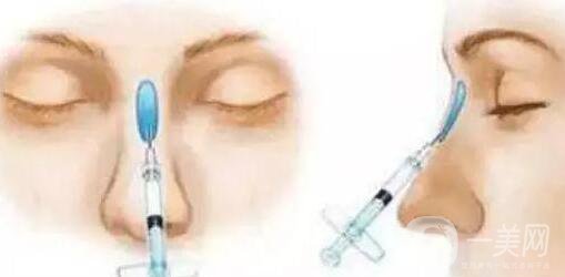 瑞蘭玻尿酸隆鼻價格需要多少?所需費(fèi)用詳解