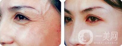 怎樣去魚尾紋*果好？去除魚尾紋的方法介紹