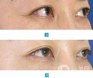 怎樣去魚尾紋*果好？去除魚尾紋的方法介紹