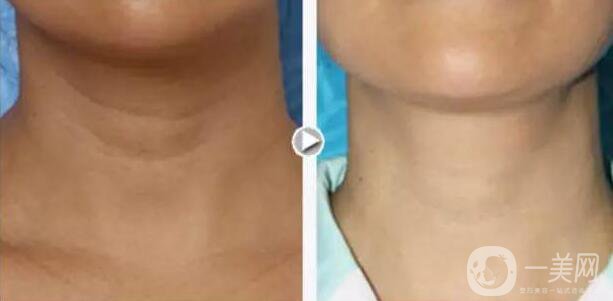 有頸紋怎么辦？去頸紋什么方法好？