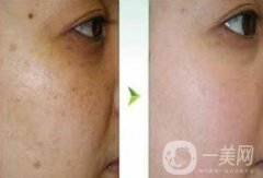 去蝴蝶斑用什么方法好？蝴蝶斑調(diào)節(jié)方法詳細介紹