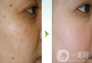 去蝴蝶斑用什么方法好？蝴蝶斑調(diào)節(jié)方法詳細(xì)介紹