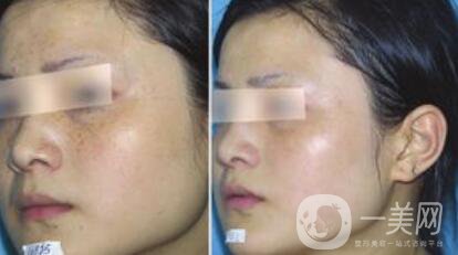 去蝴蝶斑用什么方法好？蝴蝶斑調(diào)節(jié)方法詳細(xì)介紹