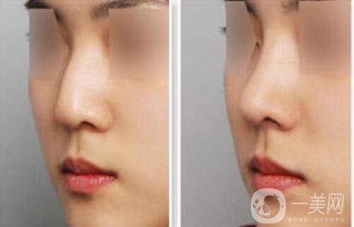 駝峰鼻矯正需要多少錢？駝峰鼻矯正費用詳解