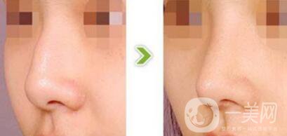 駝峰鼻矯正需要多少錢？駝峰鼻矯正費用詳解