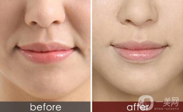 怎么除去法令紋？什么方法可以去法令紋？