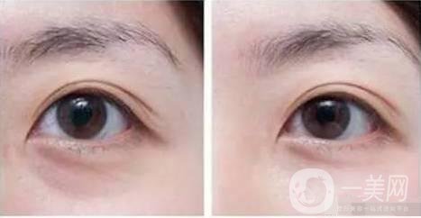 自體脂肪填充眼眶注意事項主要有哪些？