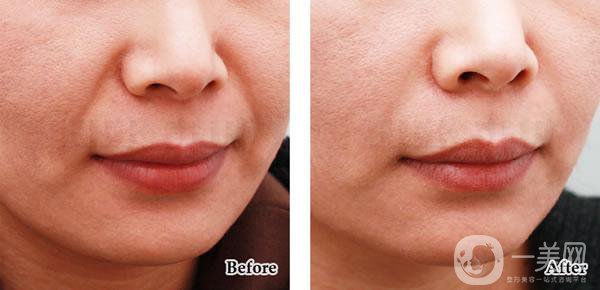 法令紋怎樣消除*果*好？該怎么樣做？