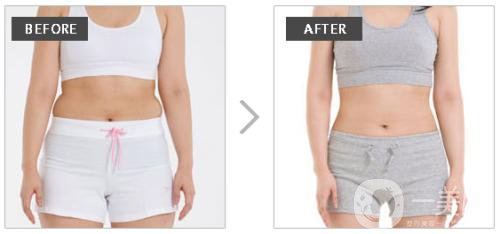 等離子激光溶脂價(jià)格是多少？于哪些因素有關(guān)？