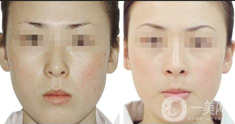 黑臉娃娃的副作用有哪些？怎樣可以減少副作用？