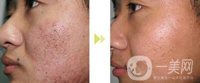 像素激光去痘坑*果怎么樣？怎樣很好的調(diào)節(jié)*果？