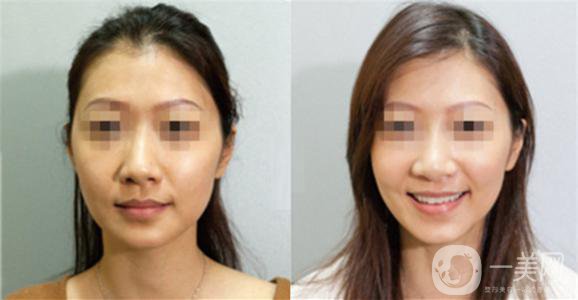 做黑臉娃娃的副作用有哪些？可以避免嗎？