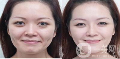 怎樣去鼻唇溝？哪些方法比較好？