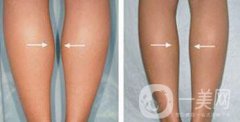 打注射瘦腿*果嗎？注射注射瘦腿作用怎么樣？