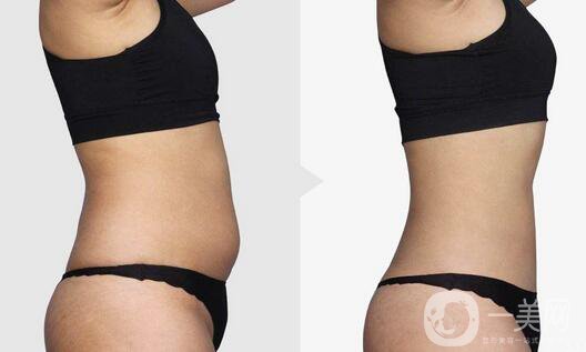 南京吸脂減肥的價格是多少？吸脂減肥大概多少錢？
