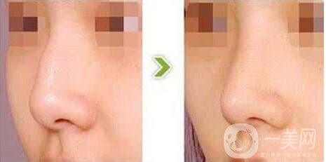 駝峰鼻,多少錢,費用詳解