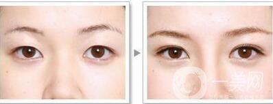 韓式三點雙眼皮能拆嗎？**果怎么樣？