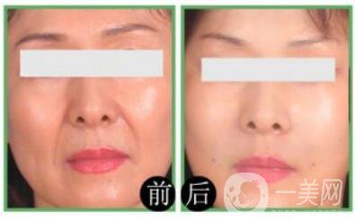 自體脂肪豐鼻唇溝*果怎么樣?自體脂肪填充鼻唇溝詳細介紹