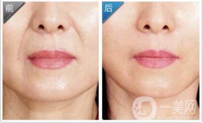 自體脂肪豐鼻唇溝*果怎么樣?自體脂肪填充鼻唇溝詳細介紹