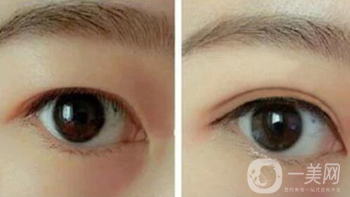 韓式三點(diǎn)雙眼皮是埋線還是割？手術(shù)*果怎么樣