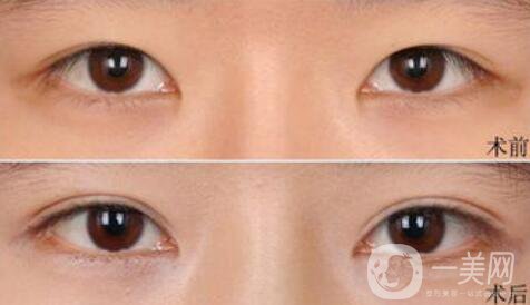 高分子埋線是*的嗎？可以維持幾年？