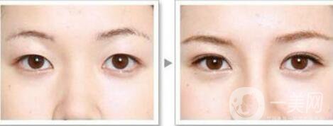 高分子埋線是*的嗎？可以維持幾年？