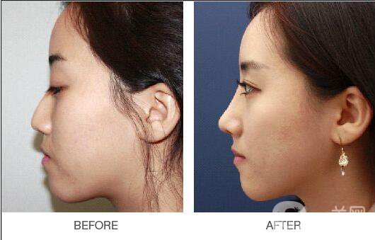 玻尿酸,價(jià)格