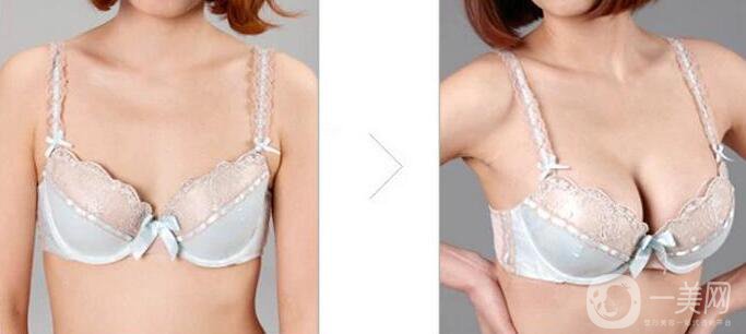 水滴型假體隆胸怎么樣？隆胸風(fēng)險(xiǎn)高嗎？